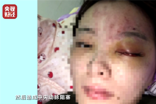央视315晚会揭秘非法医美速成班：玻尿酸打出大面积脑梗